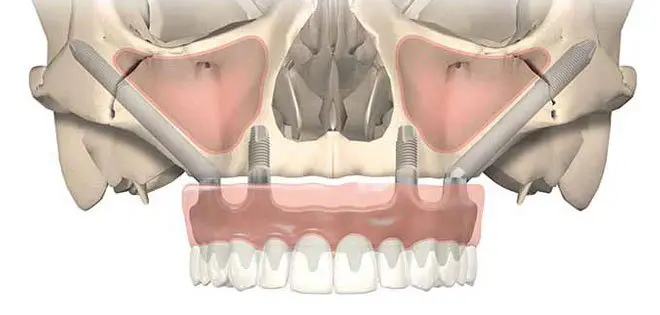 Implantes cigomáticos Madrid precio