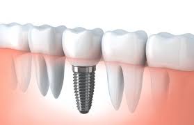 Implantes dentales Pozuelo precio