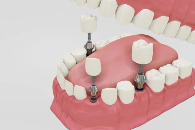 Implantes dentales en Salamanca