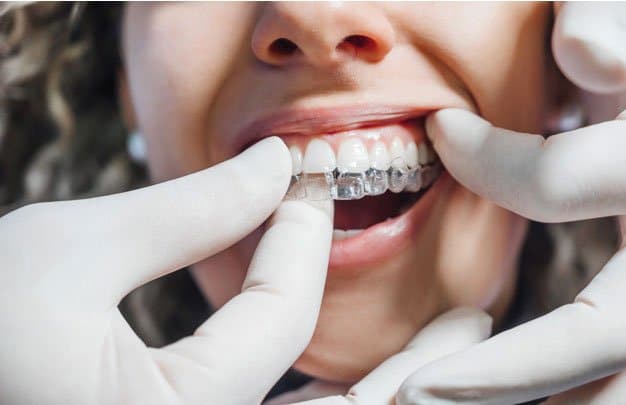 Invisalign Madrid precio