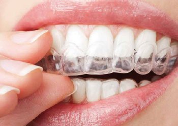 Invisalign Madrid