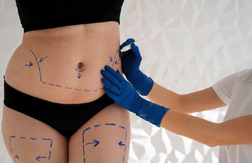 Lipoabdominoplastia