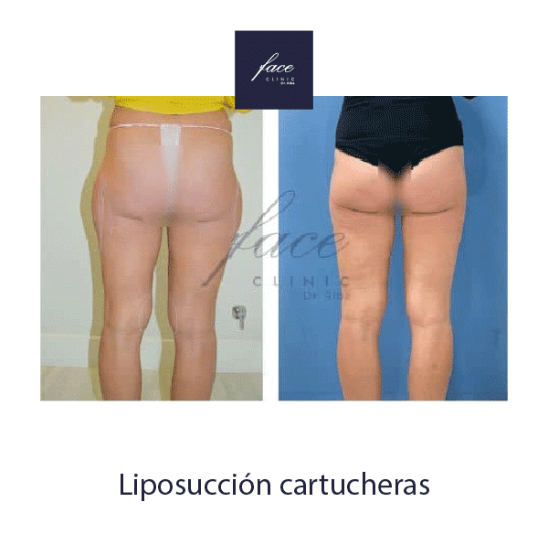 Liposucción Madrid antes y después - Caso 1