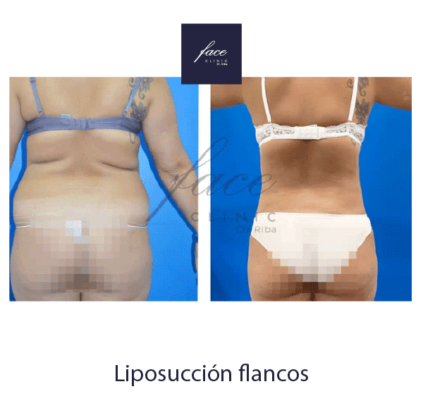 Liposucción antes y después - Caso 2