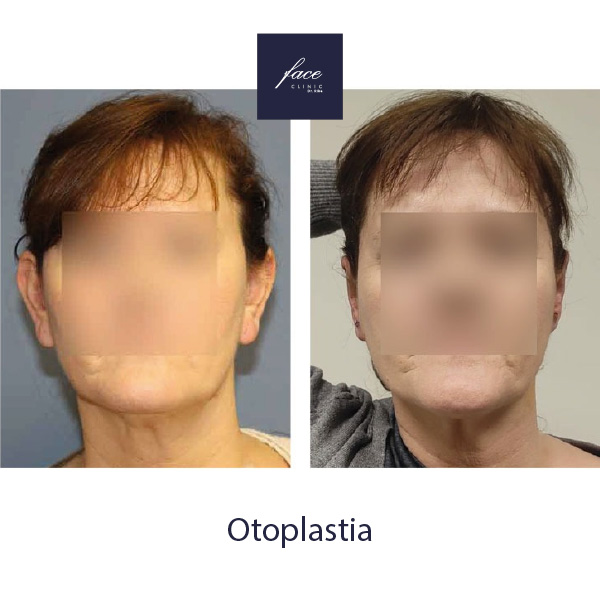 Cirugía otoplastia antes y después en Madrid
