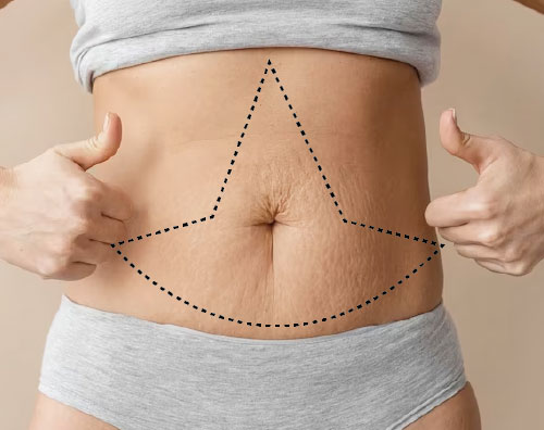 Abdominoplastia en flor de lys precio