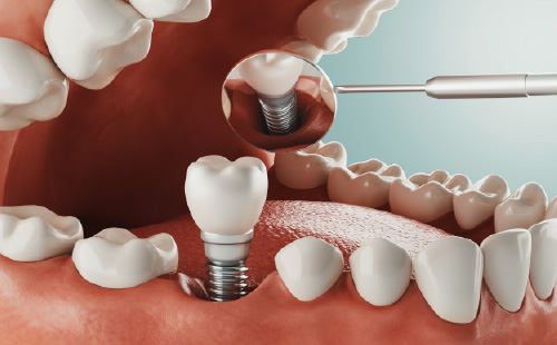 Precio implantes corticales Madrid