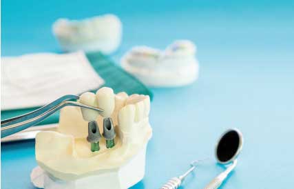 Precio implantes dentales Madrid