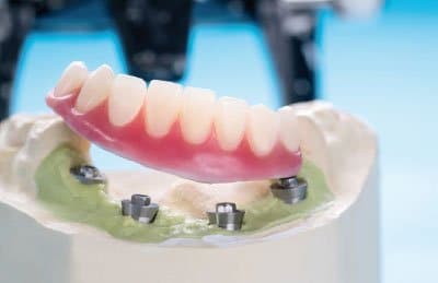 Precio implantes dentales Valladolid