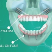 Quad Zygoma