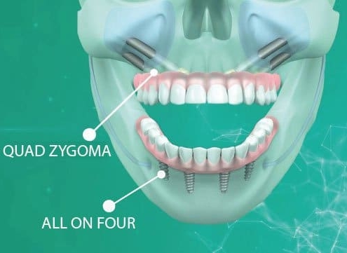 Quad Zygoma