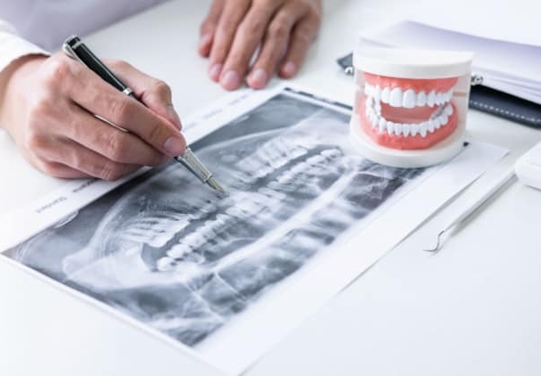 Riesgos Implantes dentales