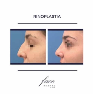 Rinoplastia ultrasónica Madrid _ antes y después