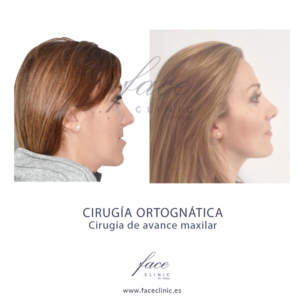 Caso antes y después 2 de cirugía ortognática Madrid