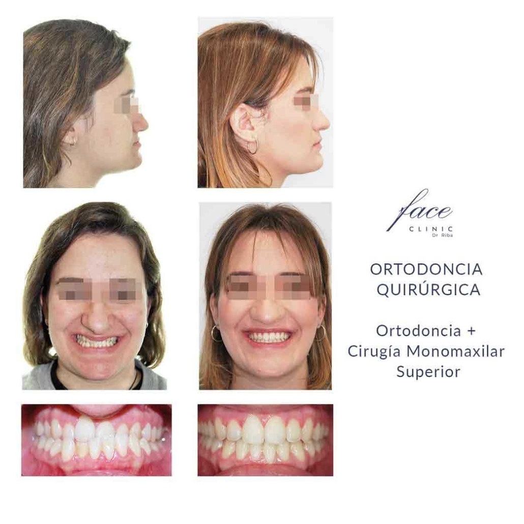 Caso antes y después 1 de cirugía ortognática Madrid