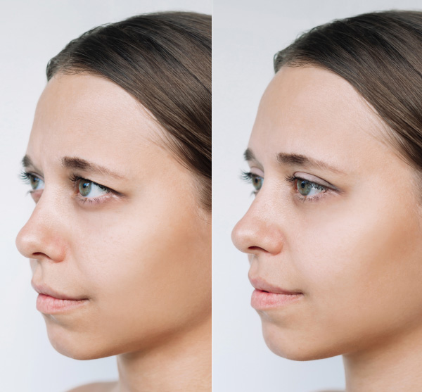 Clínica Blefaroplastia Madrid