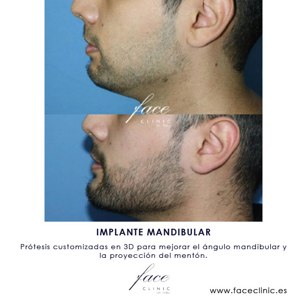 Implante manmdibular