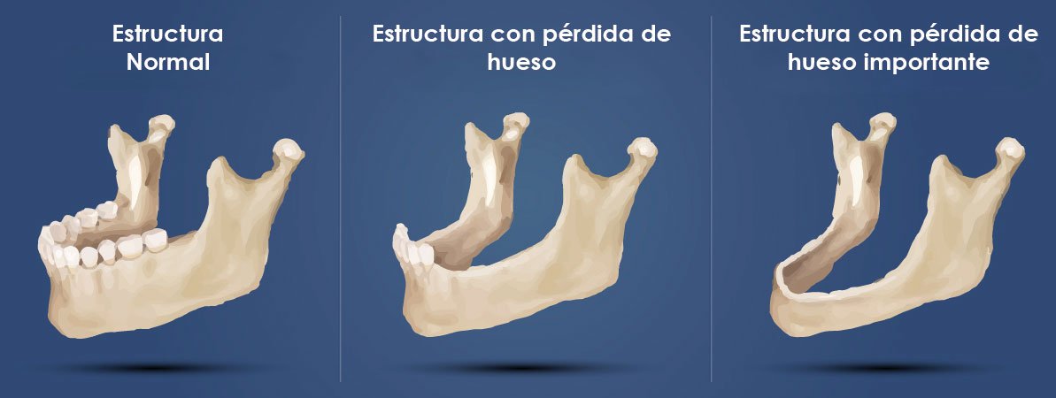 Implantes dentales sin hueso indicaciones