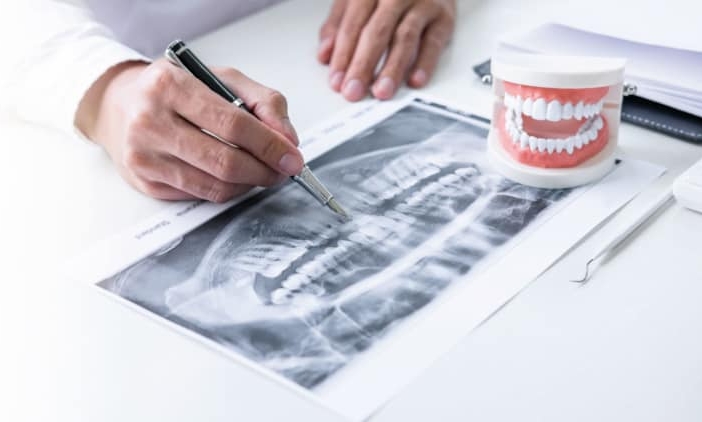 Implantes dentales sin hueso dental