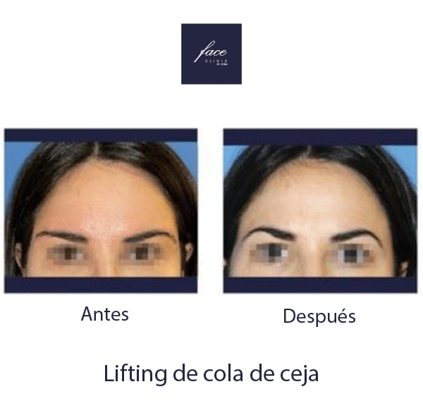 Caso antes y después de lifting de cejas en Madrid