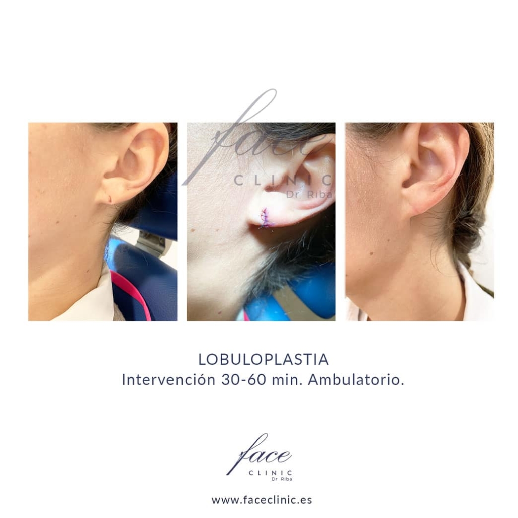 Lobuloplastia Madrid