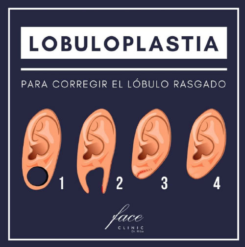 Lobuloplastia Madrid Opiniones