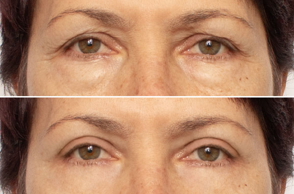 Blefaroplastia en Valladolid