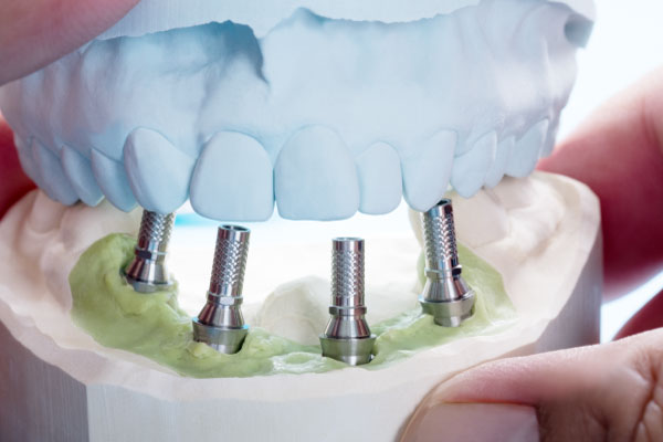 Implantes dentales de carga inmediata Valladolid precio