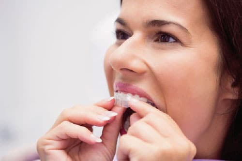 Invisalign en Valladolid