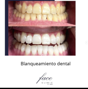 Blanqueamiento dental antes y después - caso 1