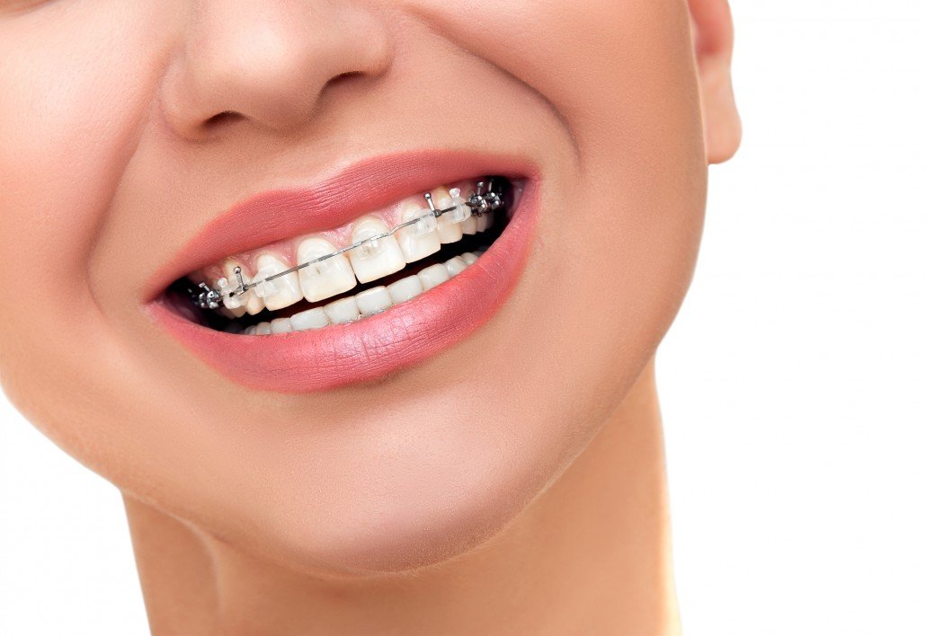 Precio brackets autoligables