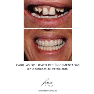 Carillas dentales antes y después