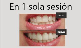 Contorneado dental antes después