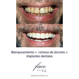 Diseño de sonrisa antes y después