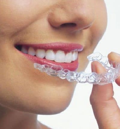 Invisalign Full