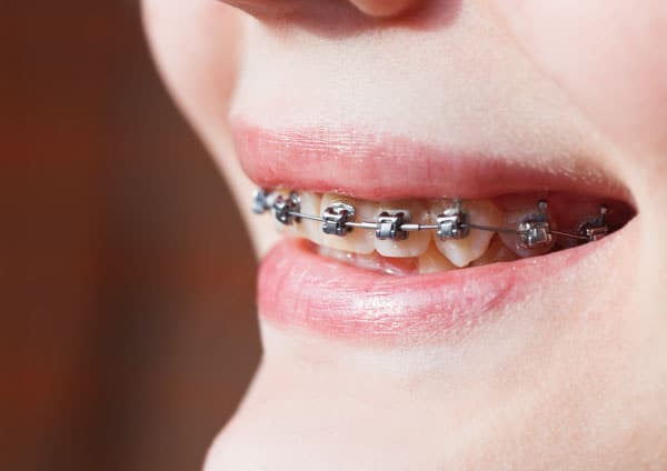 Precio brackets Damon