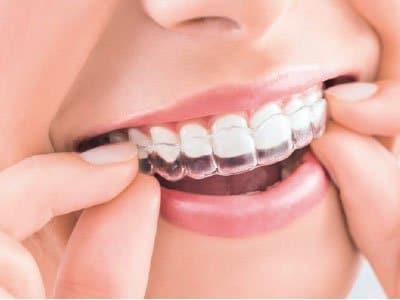 ¿Qué es Invisalign?