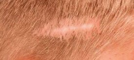 Alopecia Cicatricial