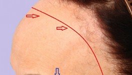 Alopecia Frontal Fibrosante
