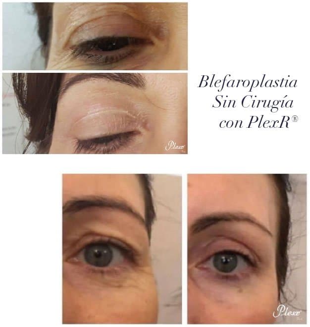 Blefaroplastia sin Cirugía