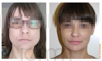 Botox bruxismo Huelva