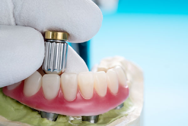 Dentadura fija sobre 4 implantes precio