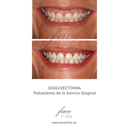 Gingivectomía antes y después