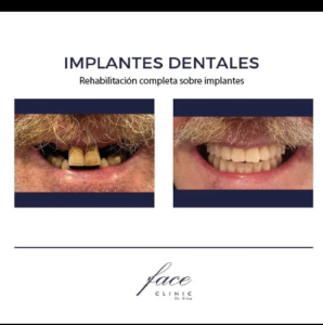 Prótesis dentales fijas antes y después
