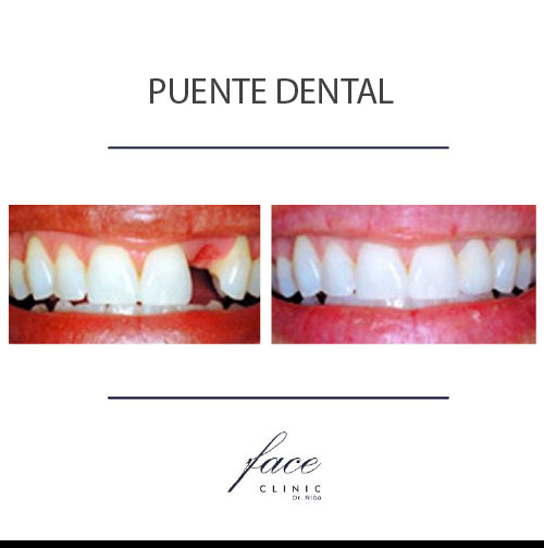 Puente dental antes y después