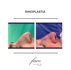 Rinoplastia hombres antes y después